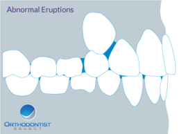 Common Orthodontic Problems in Frisco, TX - Abnormal Eruptions