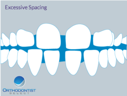 Common Orthodontic Problems in Frisco, TX - Excessive Spacing